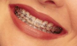 Picture of a smiling woman with dental metal braces, showing her happiness with the metal braces procedure she had in Costa Rica.