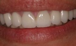 Picture of a smiling woman displaying the top teeth with metal-porcelain crowns she had in Costa Rica.