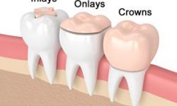 Illustration of a dental onlays-inlays procedure