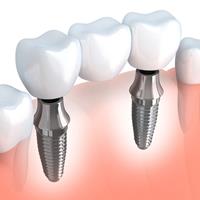 Illustration of an implant supported bridge.