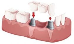 Illustration of an implant supported bridge.