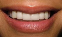 Picture of a smiling woman displaying the pure porcelain crowns procedure she had in Costa Rica.
