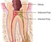 Illustration of a root canal procedure.