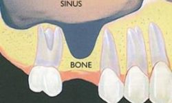 Illustration a sinus lift procedure.