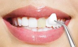 Picture of a smiling woman displaying the dental veneers procedure she had in Costa Rica.