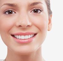 Picture of a smiling woman displaying the dental veneers procedure she had in Costa Rica.