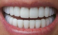 Picture of a smiling woman displaying the top teeth with zirconium crowns she had in Costa Rica.