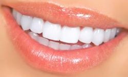 Picture of a smiling woman displaying the top teeth with zirconium veneers she had in Costa Rica.