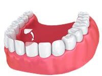 Illustration of a dental bonding procedure.