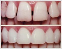 Before and after picture of a dental bonding procedure.